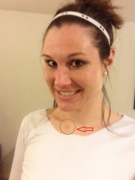 But I still have the hickey.